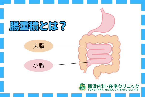 腸重積